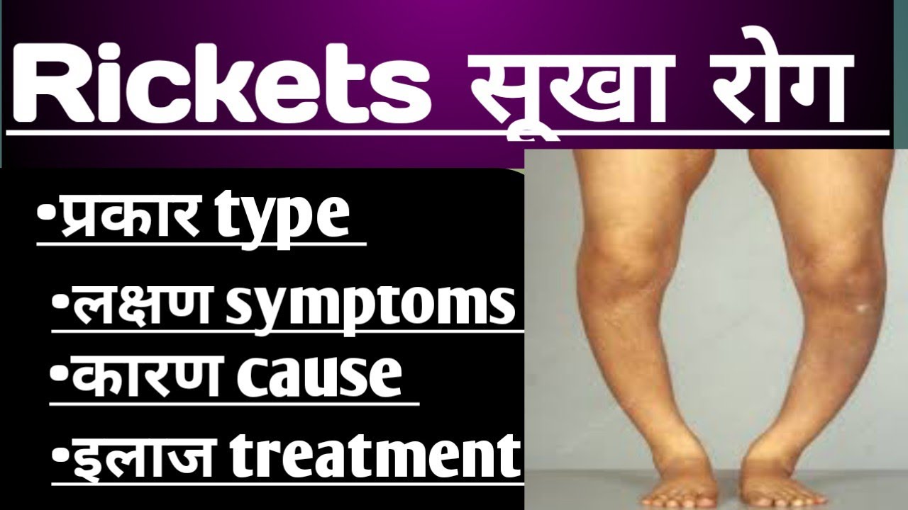Rickets vitamin deficiency 👌/🔥सूखा रोग/ उपचार/ सूखा रोग के लक्षण/ सूखा ...