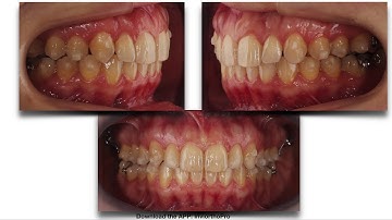 Invisalign TO SOLVE SEVERE CLASS II, CROWDING  AND DEEPBITE