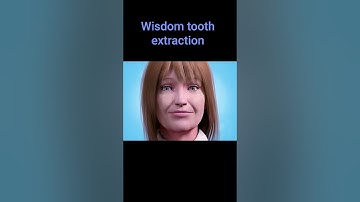 Nhổ răng khôn mọc nghiêng 45 độ