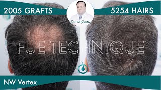 Hair Graft Technique FUE - 2005 Grafts (5254 Hairs) - Dr. Rafael de Freitas
