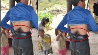 Người mọc đuôi ở Hà Giang: Vừa cắt đuôi thì lăn ra... ốm