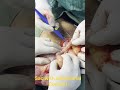 Large Incisional Hernia containing Small ,Large bowels and Omentum, repaired successfully 👍