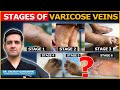 What are the stages of varicose veins   dr gaurav gangwani interventional radiologist