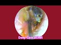 ASMR Ear Cleaning | Guaranteed Tingles and Instant Relaxation