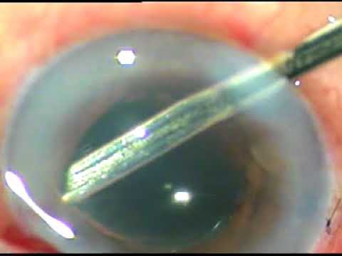 Video: Iris Bombe Hauv Cat - Cov Qhov Muag O Hauv Cat - Posterior Synechiae Hauv Miv