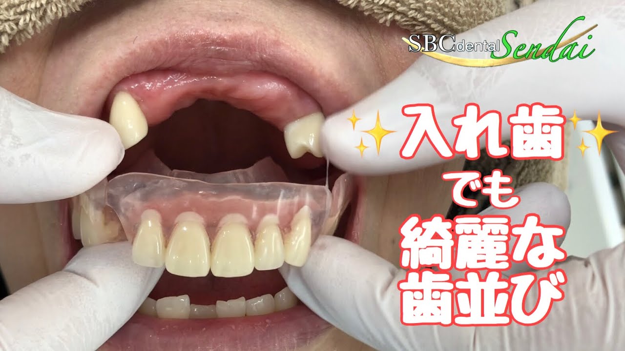 金具のない入れ歯（エステティックデンチャー）