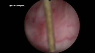Prostatic Utricle Cyst