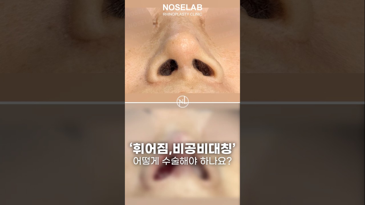 휘어진 코 재수술, 30년&middot;6번 수술에도 해결되지 않았다면? 비중격연골 재건이 답일 수 있습니다