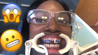 I Got Braces... Closing My HUGE Gap | Starring Shameka