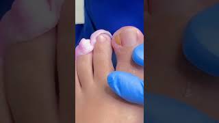 Uña encarnada con granuloma! #ingrown_toenail_surgery