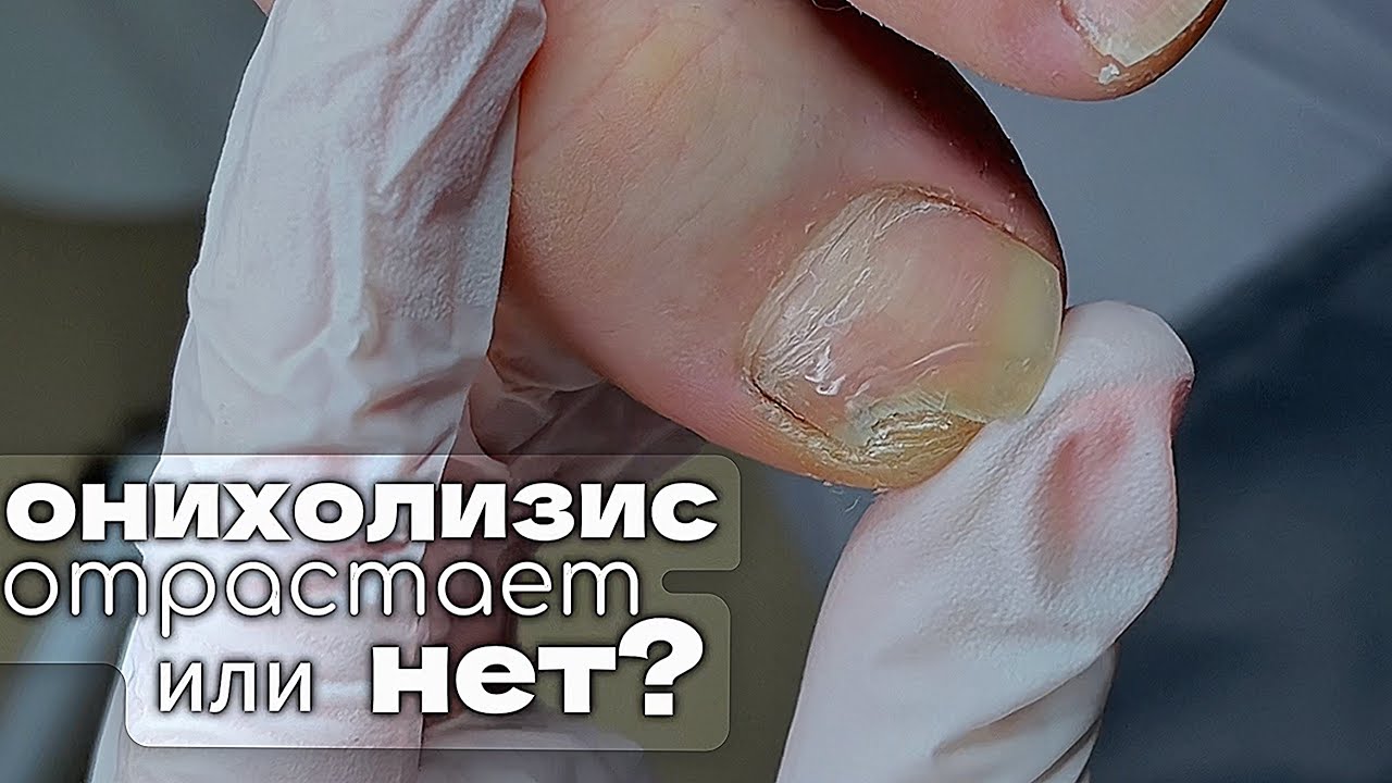 онихолизис НЕ ОТРАСТАЕТ после обработки?
