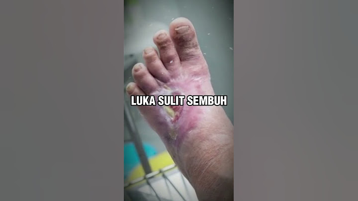 NGERI !!LUKA INI PERTANDA DIABETES #kesehatan