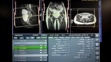 MRI Pelvis | CA Cervix MRI Protocol & Planning Tutorial (SIEMENS 1.5T / 3T)