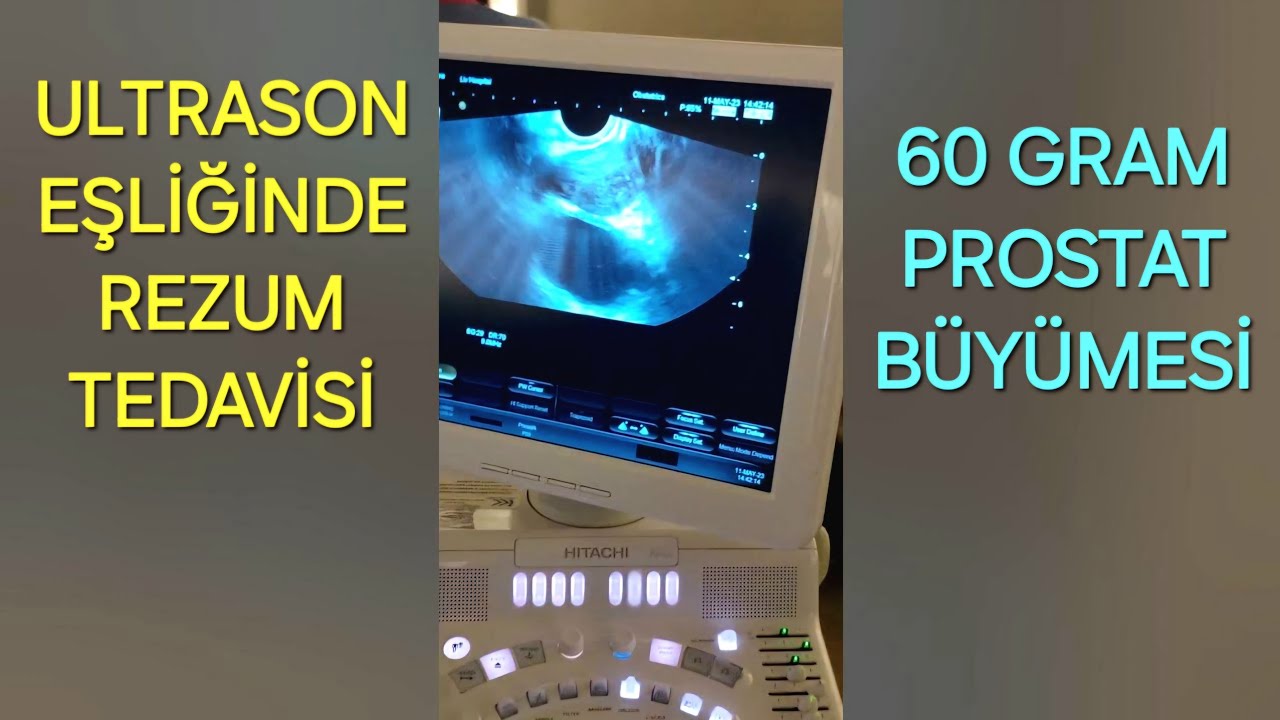 Rezum Prostat Tedavisi Ultrason Eşliğinde 60 GRAM Prostat Büyümesine ...