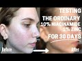 I Tried The Ordinary Niacinamide 10% Zinc 1% On My Acne Scars for 30 Days | HONEST REVIEW