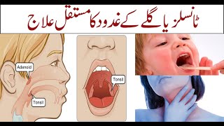 Permanent Treatment of Tonsils or Throat Glands | Tonsillitis symptoms and treatment