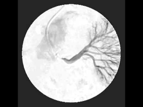 Occlusione arteria renale sinistra trattata con PTA e stent.
