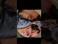 Jigger Removal #shorts  72632
