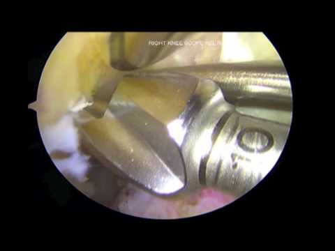 Anatomic ACL Reconstruction using an Anteromedial portal