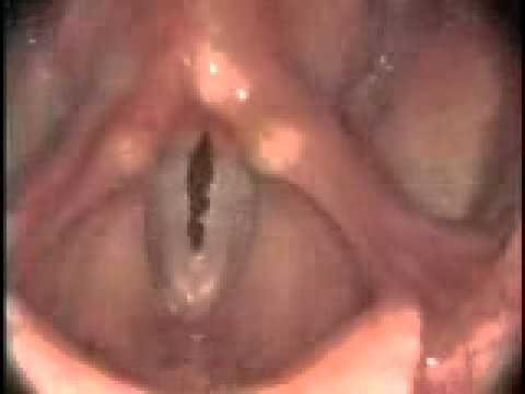 Stroboscopy: Rigid: Normal female vocal cords