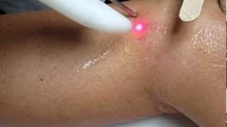 Spider Veins Laser Treatment-Fotona Nd:Yag 1064 nm Laser