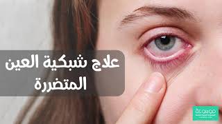 كيفية علاج شبكية العين  ..اعراض انفصال الشبكية وعلاجها