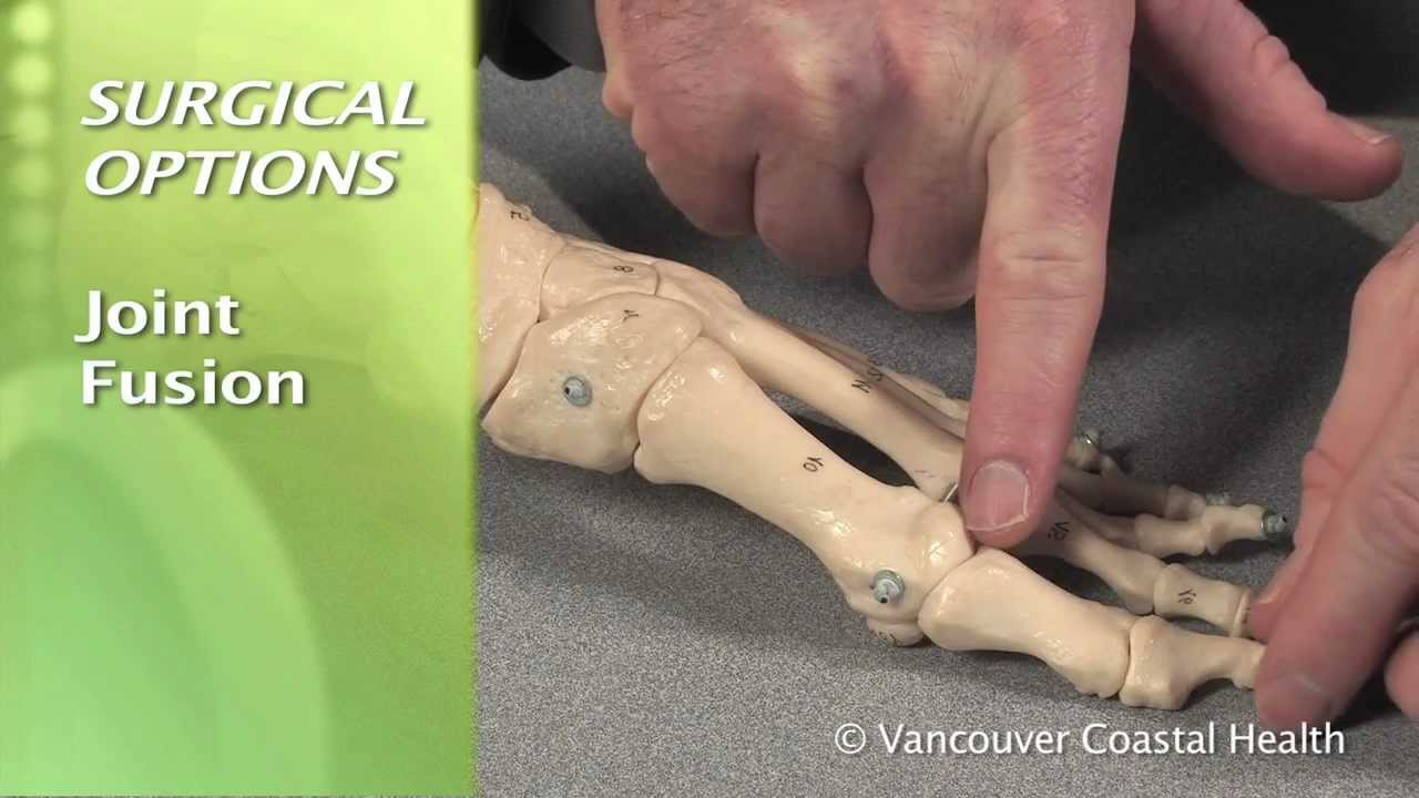 Osteoarthritis of the Big Toe YouTube