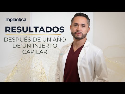 🧑‍🦲Injerto Capilar a un año [RESULTADO PEPE GOITIA] 🧑‍🦱✅