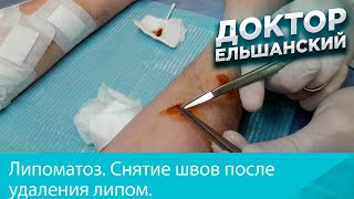 Снятие швов после удаления множественных липом при липоматозе