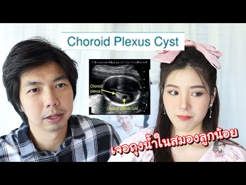 ตรวจเจอถุงน้ำในสมองลูกน้อย Choroid Plexus Cyst l AE มาเอง