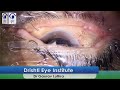 Live Cataract Surgery | Tecnis Toric Lens Implantation by Dr. Gaurav Luthra