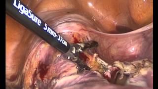 Laparoscopic hysterectomy only two port in 9 minute!(Prof.Dr.Mehmet YILMAZER,Dr.Osman KARAÇİN)