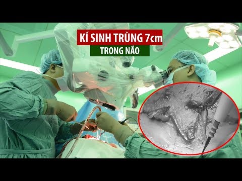 Video Phẫu thuật lấy kí sinh trùng dài 7cm trong não bệnh... - YouTube