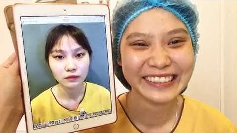 Cắt Mí Mắt Xếch Bằng Mani Mini Deep 5D Tại Dr.Hải Lê.