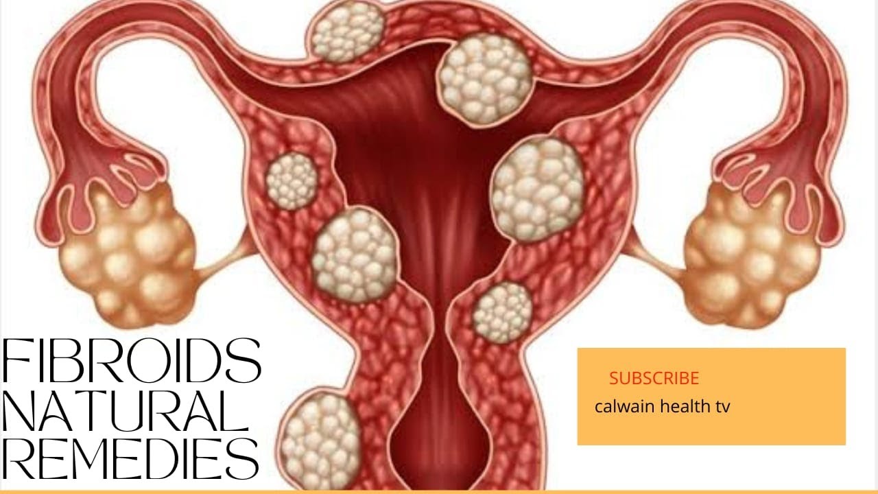 Natural Solutions for Shrinking Fibroids.