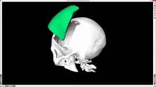 Famous Semi-Automatic Planning of Cranial 3D Implants under MeVisLab Wealth