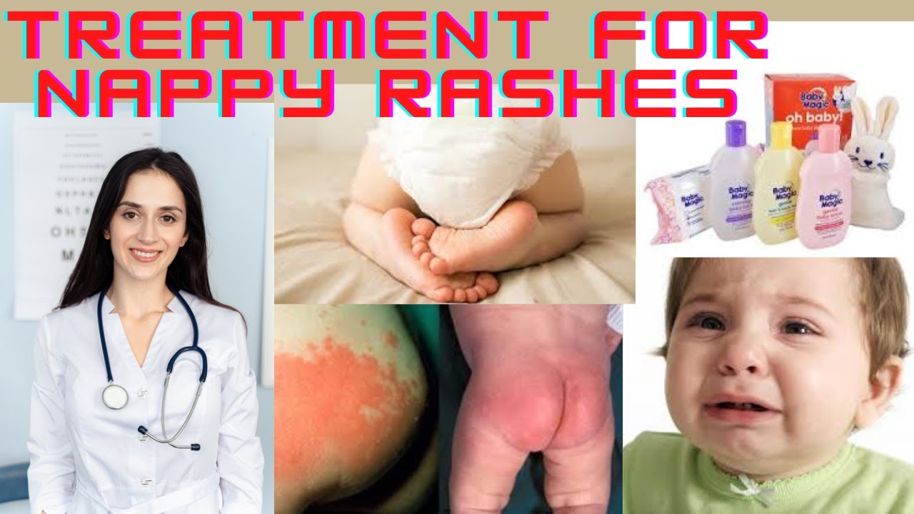 TREATMENT FOR BABY RASHES