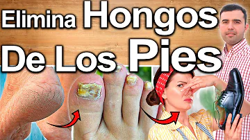 ¿Cómo quitar los hongos de los pies en un día?