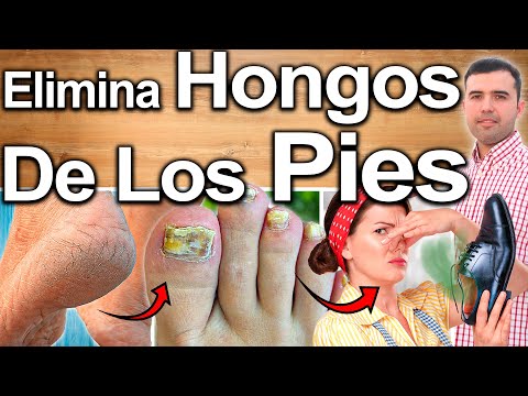 Video: 6 formas de deshacerse de los hongos en los pies