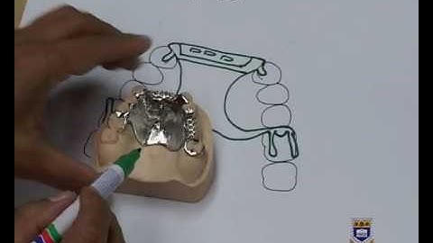 Designing an Upper Metal Partial Denture Kennedy Class IV