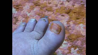 Biological Repair Pencil Scam for Toenail Fungus Use