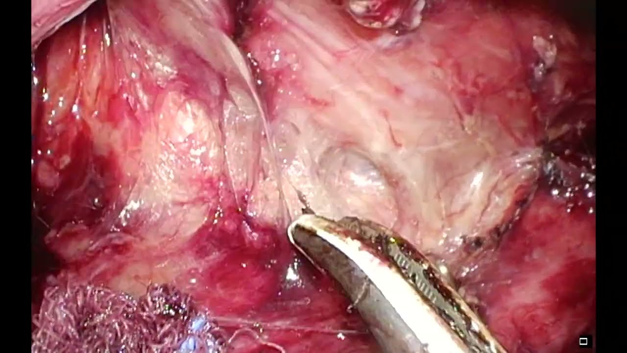 Esophagectomy- left recurrent laryngeal nerve lymph node dissection