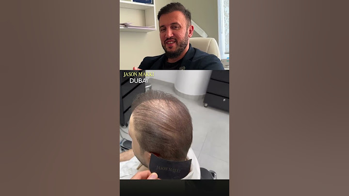 НЕ ДЕЛАЙТЕ ПЕРЕСАДКУ ВОЛОС