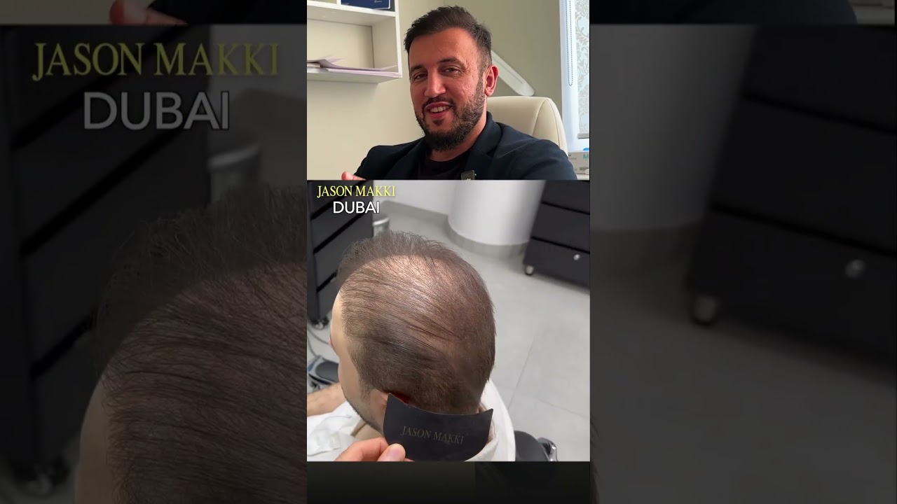 НЕ ДЕЛАЙТЕ ПЕРЕСАДКУ ВОЛОС