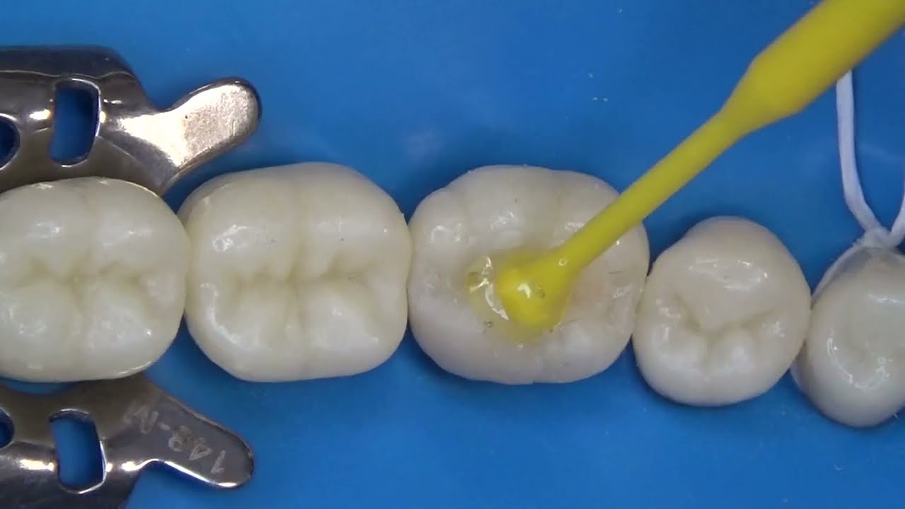 Restauração Semi Direta