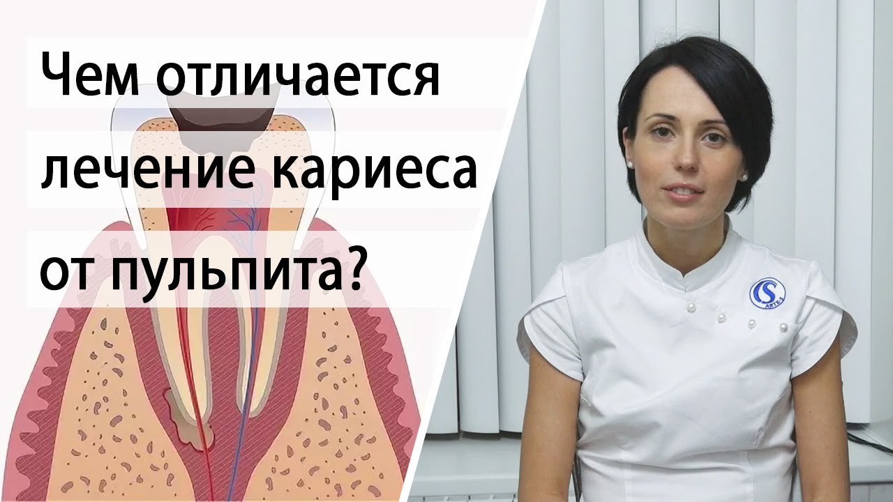 Чем отличается лечение кариеса от пульпита? - YouTube