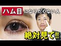 【二重整形】眠そうな「ハム目」の原因って？｜失敗する人の特徴とは？【水の森美容クリニック】