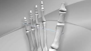 Hallux Valgus Repair with Arthrex® Mini TightRope®