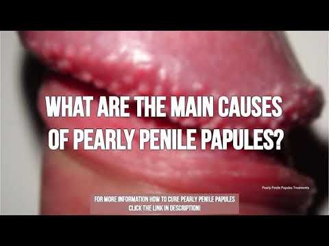 What are the Main Causes of Pearly Penile Papules?