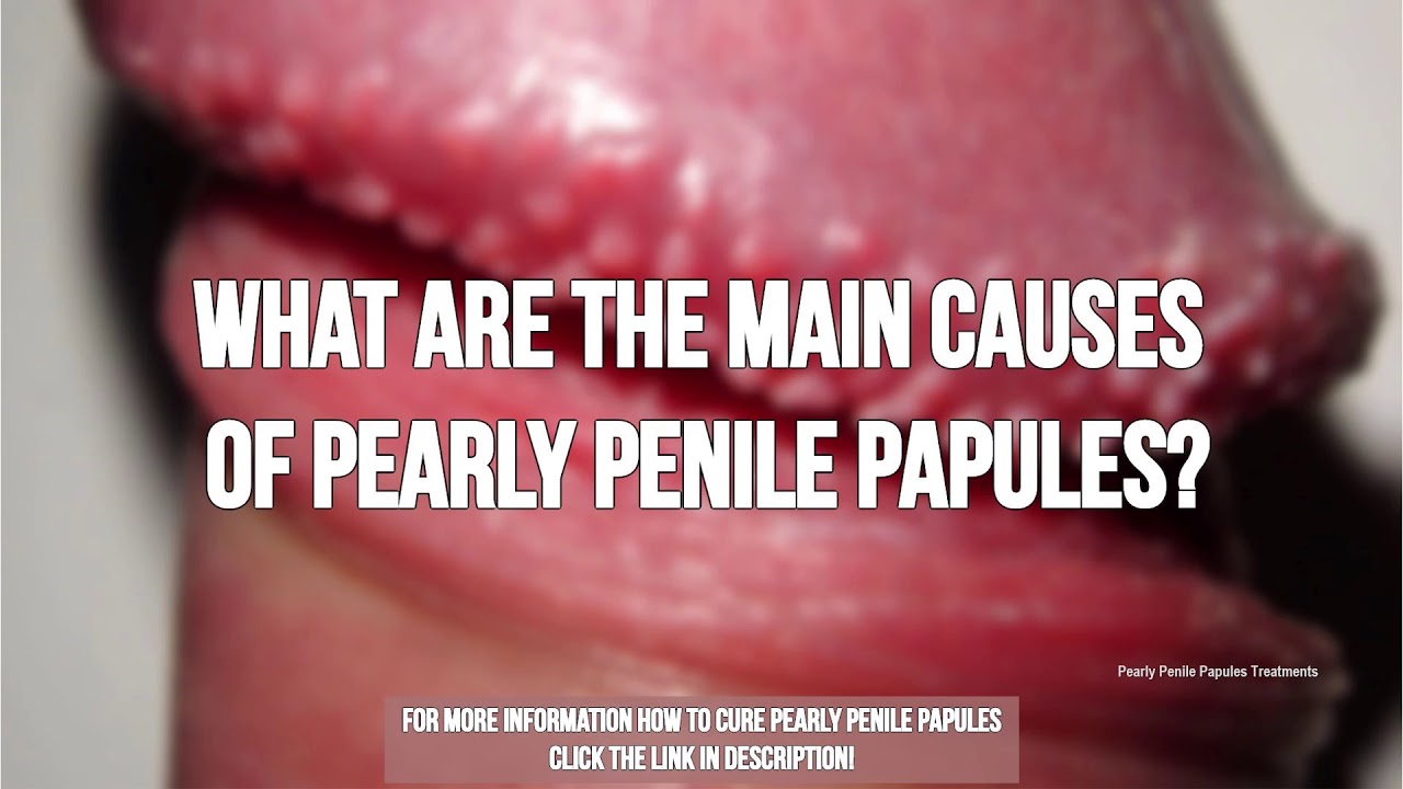 Pearly Penile Papules Treatments.